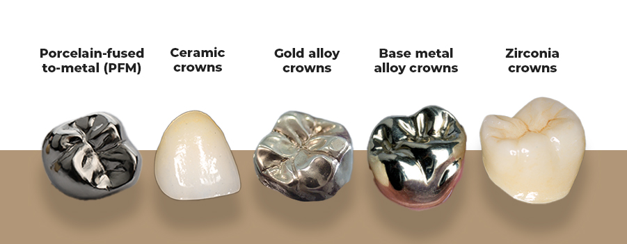 أنواع تيجان الأسنان