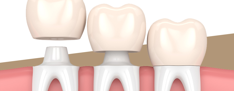 What does a dental crown look like