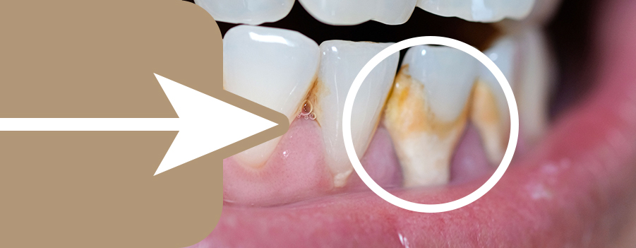 Tartar or dental calculus on the teeth