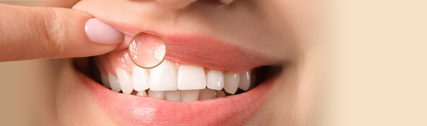 White gums symptoms, causes and treatment