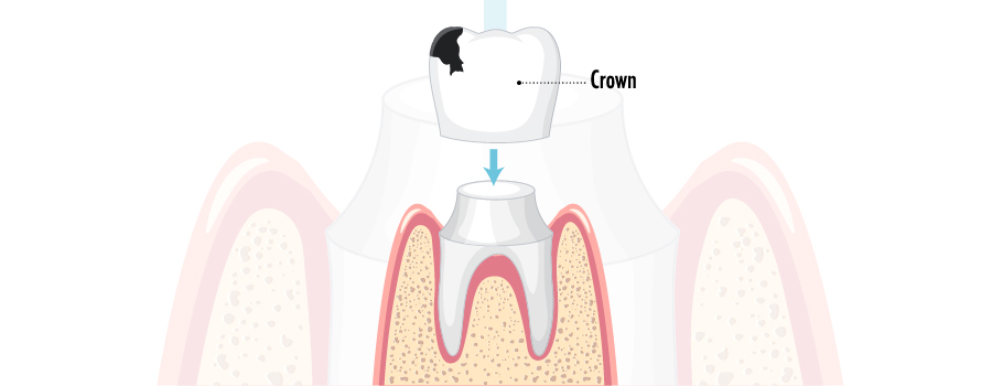 Crowns fracture
