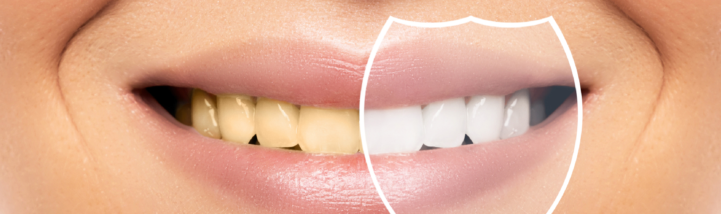 Are yellow teeth stronger than white teeth? Dentakay