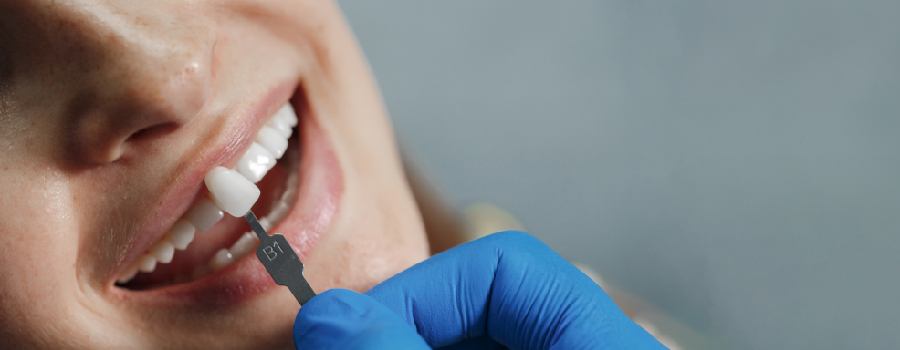 عملية الحصول على تاج الأسنان - الخطوة الثالثة عملية وضع التاج على السن