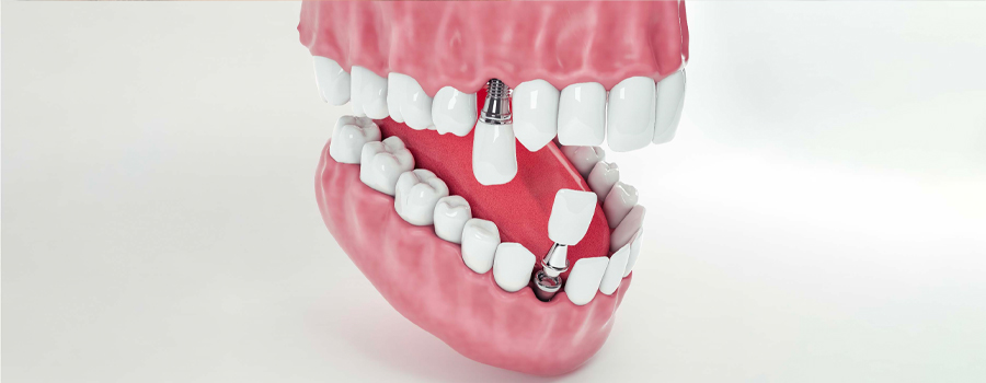 Dental implant - Cosmetic dentistry