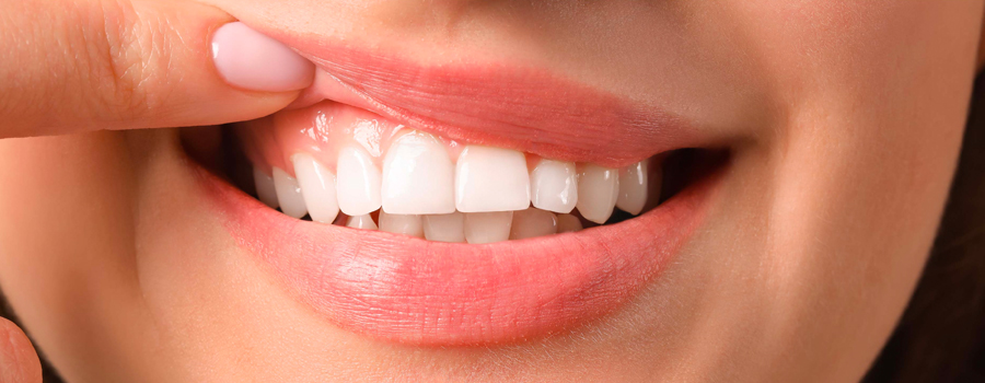 Zahnfleischkonturierung oder Zahnfleischlifting - Kosmetische Zahnmedizin
