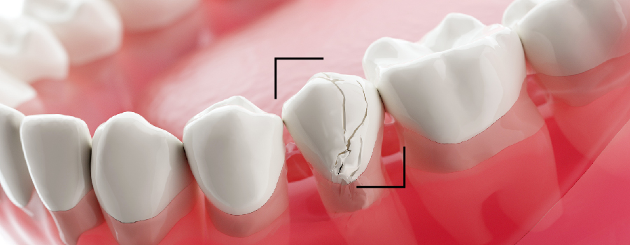Damaged dental crown needs to be repaired