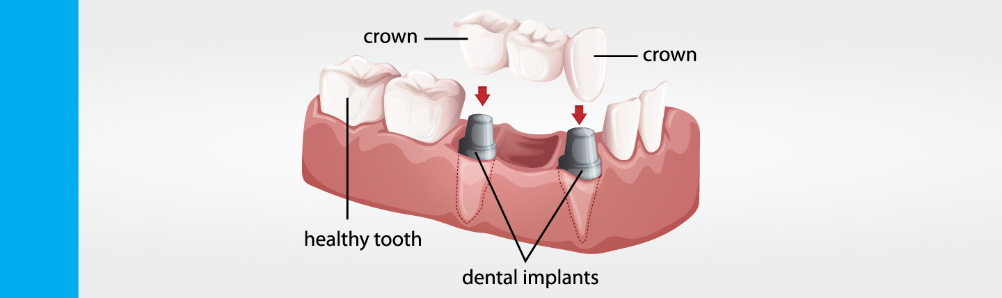 procedimiento de coronas dentales