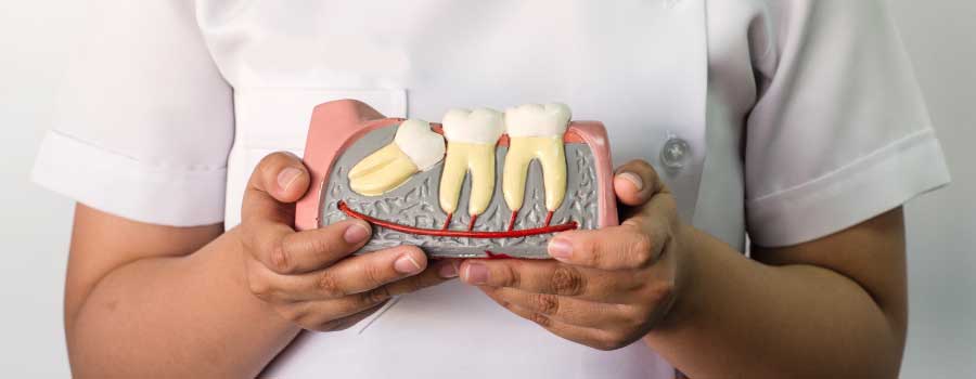 Wisdom teeth (third molars)