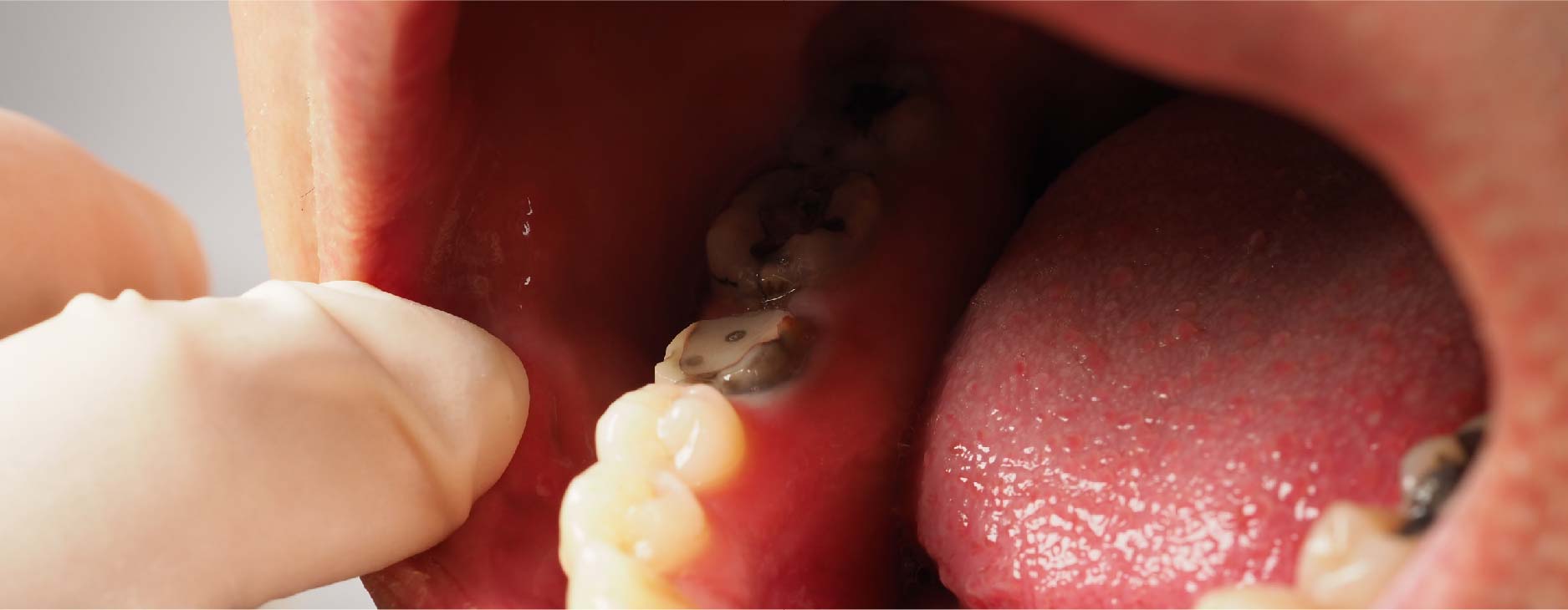 cyst around the impacted tooth