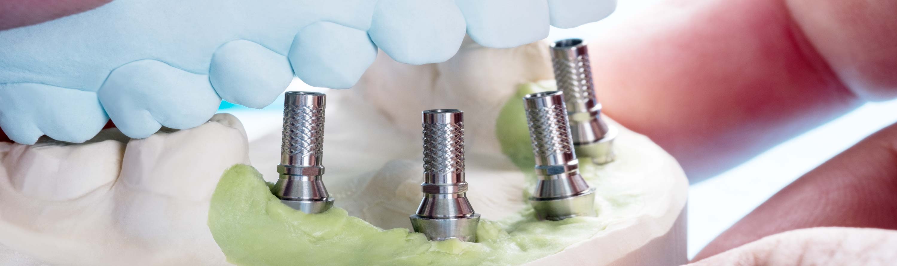 dental implant healing stages