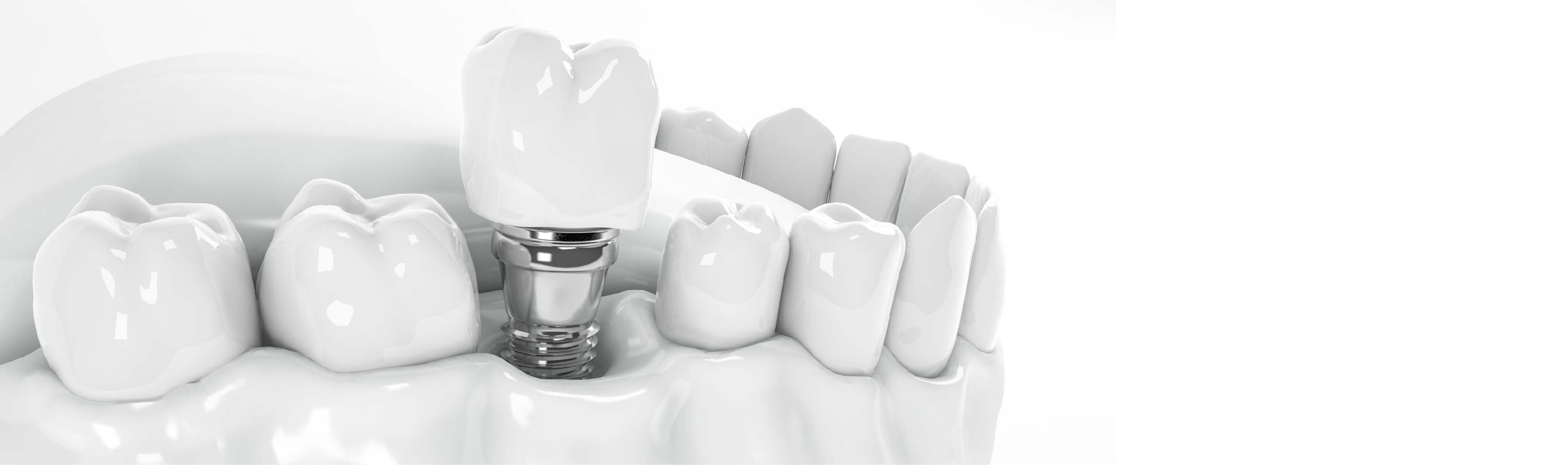 Dental implants process step by step