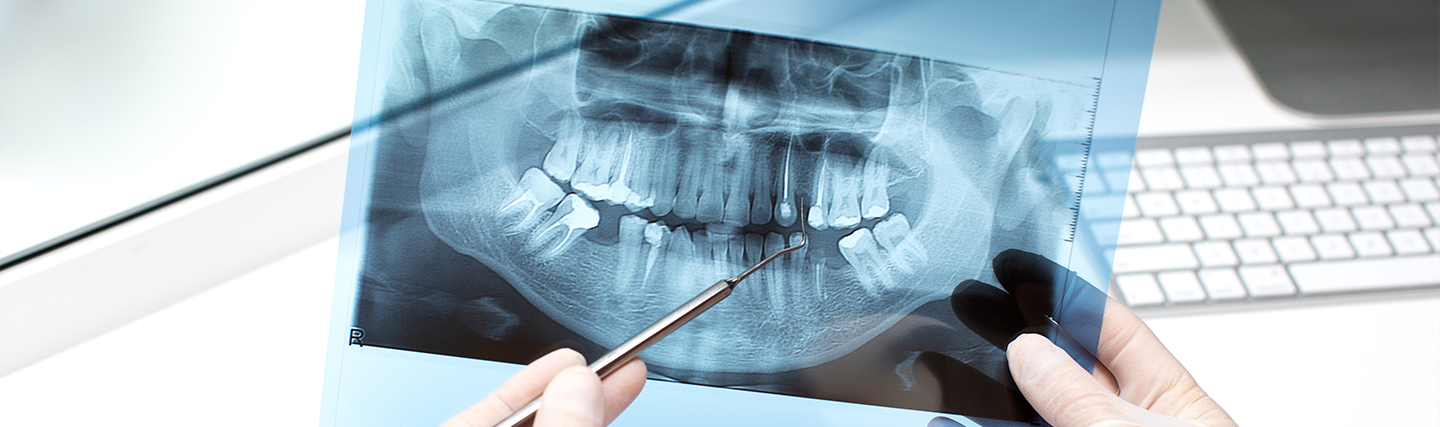bone dental graft Dentakay