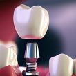 implante dental después injerto óseo