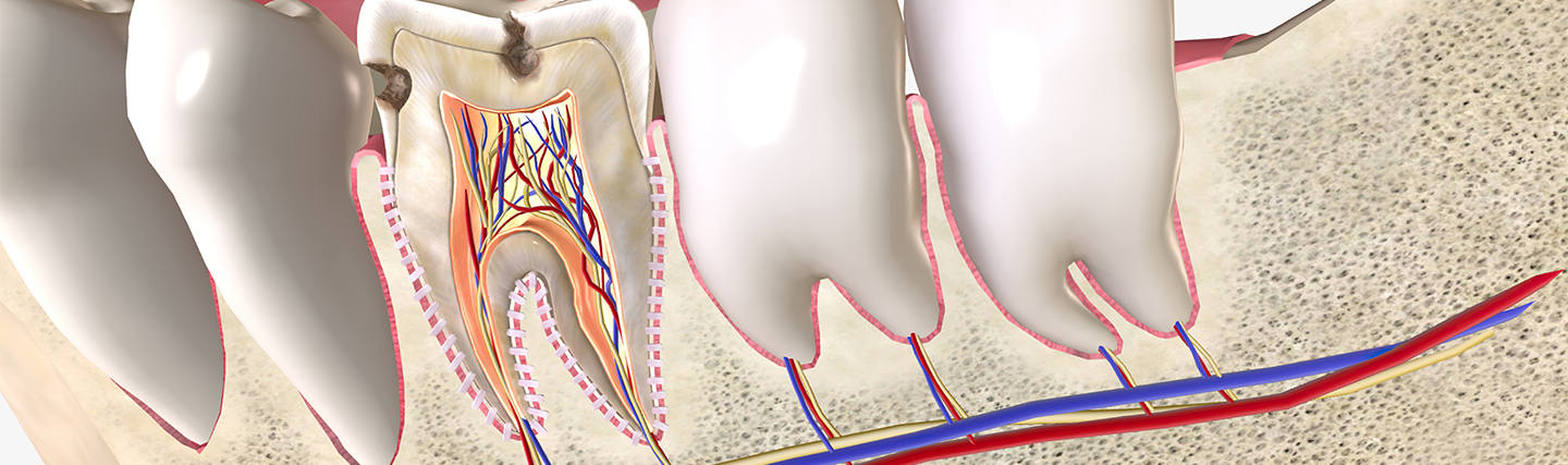Diş siniri nasıl alınır