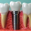 Can a Dental Implant be Removed