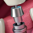 How Long Does a Dental Implant Take?